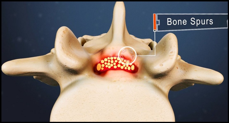 Lumbar Treatment in Delhi