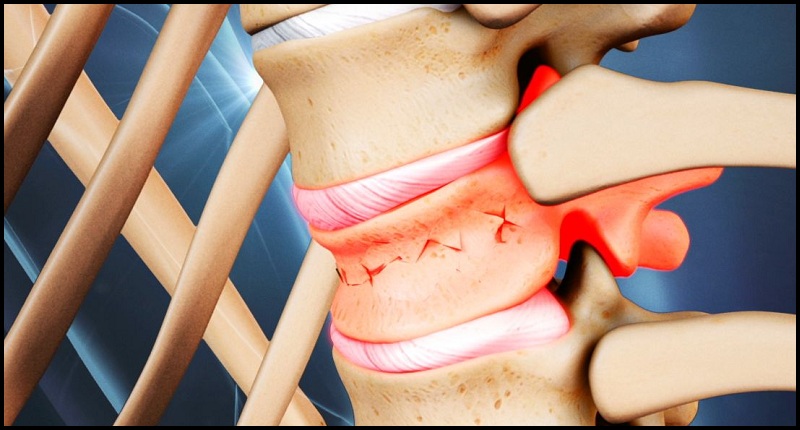 Spinal Treatment in Delhi