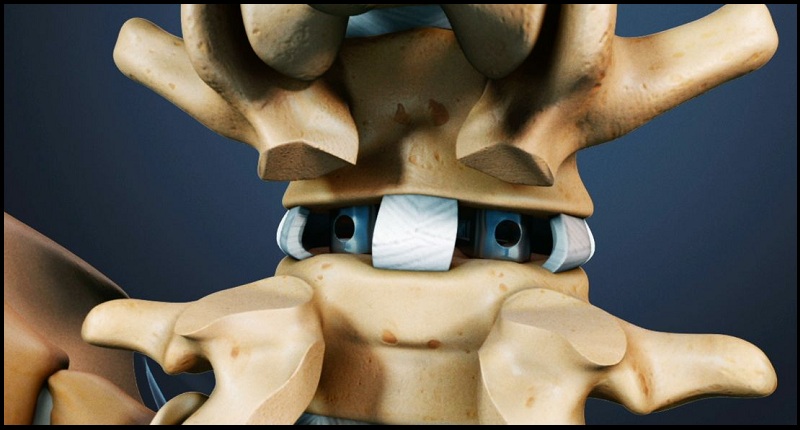 Spinal Fusion Surgery