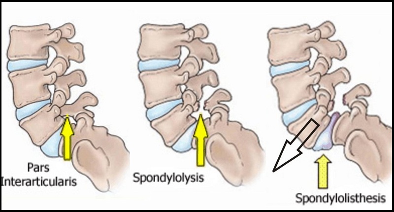 Spondylitis specialist in South Delhi